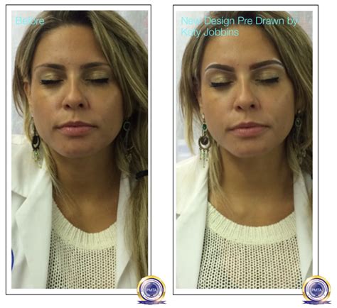 The precise release of the eyebrows, freeing buckled, bunched up muscles using the deep plane approach has taken years of. Safe and Simple Alternative To Surgical Brow Lift - Katy ...