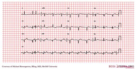 Premature Atrial Contraction Electrocardiogram Wikidoc