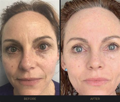 List 94 Pictures Microneedling Pictures Before And After Excellent