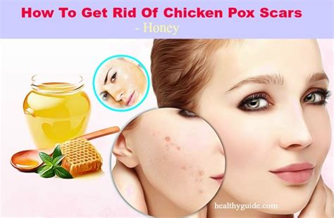 23 Tips How To Get Rid Of Chicken Pox Scars On Face Fast Naturally In
