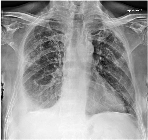 Chest X Ray Showing Moderate Right Sided Pleural Effusion And Bilateral