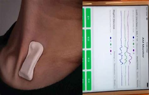 How are acute cardiac complications managed in patients with coronavirus disease 2019 concluded that numerical reduction in time to clinical improvement in those treated earlier requires confirmation in larger studies. New plaster-like gadget can detect early signs of ...