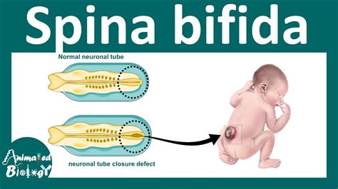 Spina Bifida What Is The Main Cause Of Spina Bifida What Are The 3