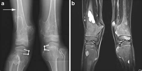 Bone Cysts And Osteochondromas Are Shown Around The Knees At Age 10