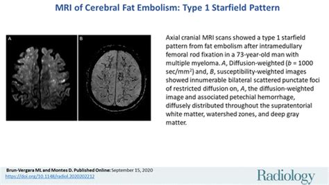 MRI Of Cerebral Fat Embolism Type 1 Starfield Pattern Radiology