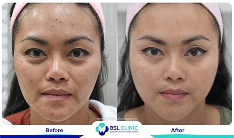 Skin Brightening And Whitening Treatment Bangkok Aesthetic Clinic