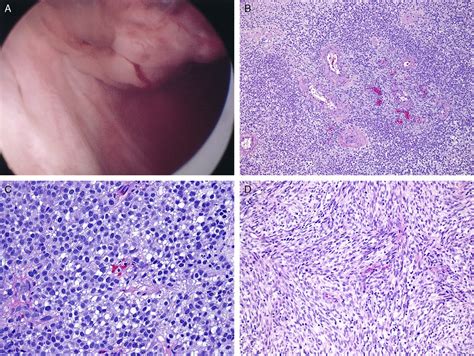 Malignant Perivascular Epithelioid Cell Neoplasm Pecoma Of The