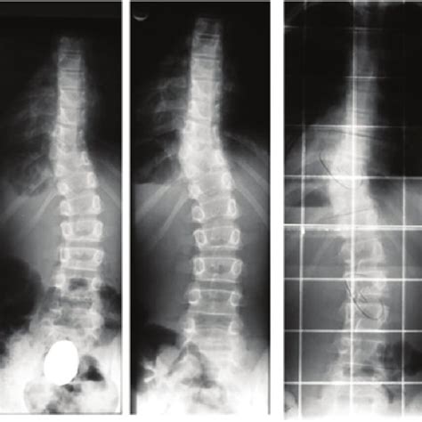 Follow Up Of Surgically Treated Patients With Congenital Scoliosis