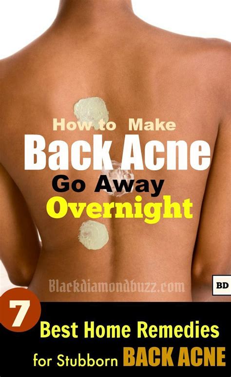 How To Get Rid Of Back Acne Overnight 7 Best Home Remedies For Backne Causes Of Back Acne The