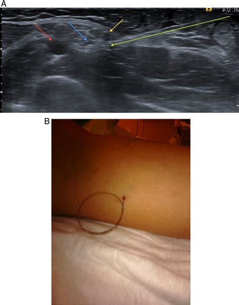 Removal of non-palpable Implanon with the aid of a hook-wire marker