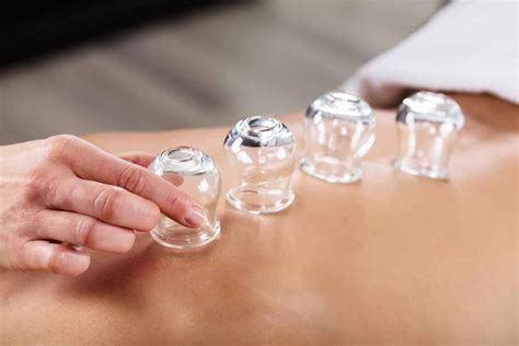 Cupping Therapy In Broadmeadows The Melbourne Chiropractor Blog