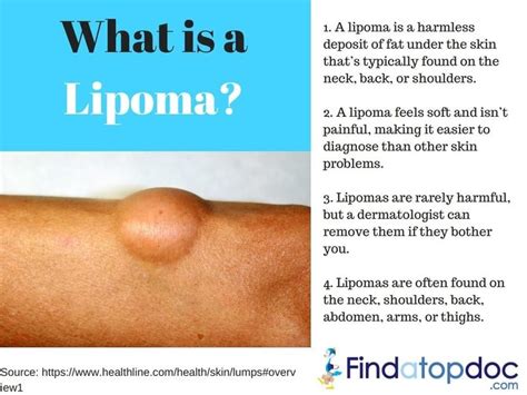 Lipoma Symptoms Causes Treatment And Diagnosis Findatopdoc