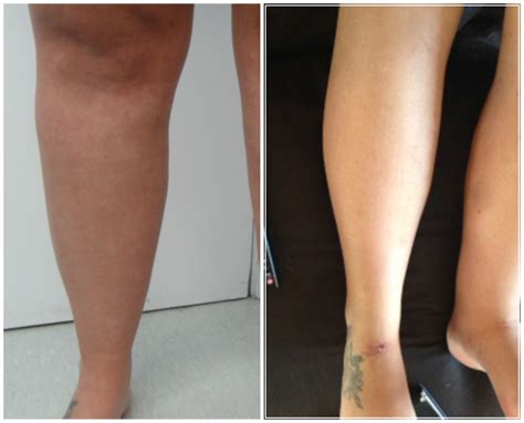 Lipoedema Liposuction Treatment For Lipoedema Lymphoedema Clinic London