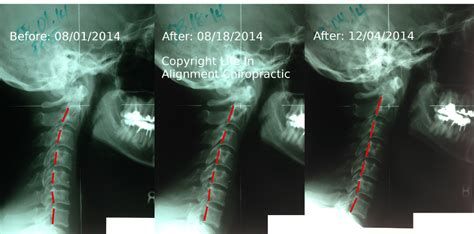 Lordosis Archives Chiropractor Auburn Hills Mi 48326 Upper Cervical Care