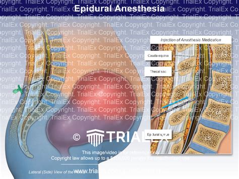 Epidural Anesthesia Trial Exhibits Inc