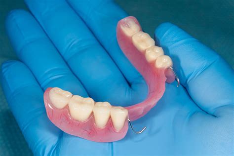 Removable Partial Dentures Implants Pro Center