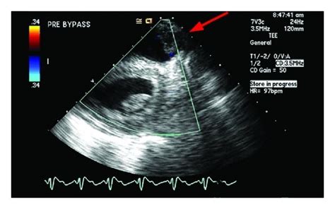Intraoperative Epicardial Ultrasound Imaging Of The Right Ventricular