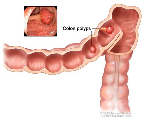 Colon Cancer Stages Importance Of Early Detection Colonoscopy MD