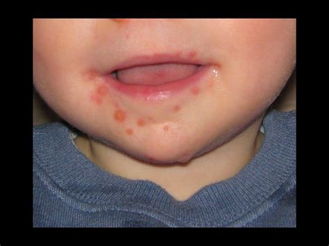 What Is Hand Foot And Mouth Disease Centurion Rekord