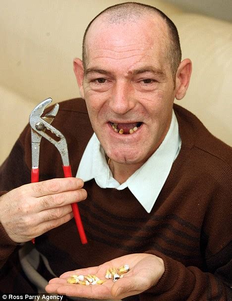 Man Pulls Out 13 Of His Own Teeth With Pliers Because He Couldnt Find An Nhs Dentist Daily