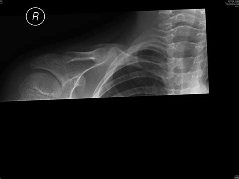 Congenital Pseudarthrosis Of Clavicle Illustrated Operative Technique