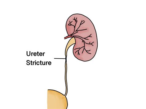 Reconstructive Urology Surgery AARE UROCARE Female Urology Urinary Incontinence Singapore