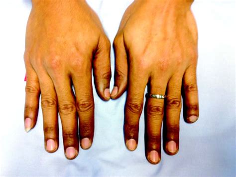 Hand Foot Syndrome Or Palmar Plantar Erythrodysesthesia Ppe