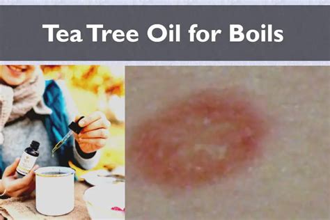Tea Tree Oil For Boils Get Rid Of Painful Bumps In 5 Steps