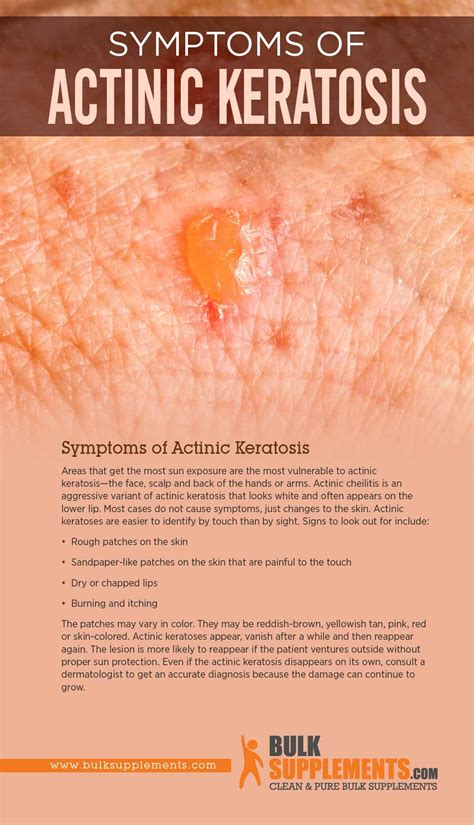 What Is Actinic Keratosis Symptoms Causes Treatment