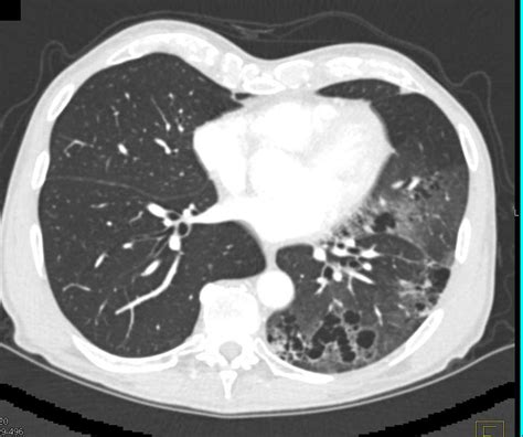 Inflammatory Changes Left Lower Lung With Cystic Air Spaces Chest