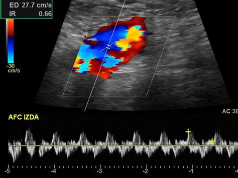 aneurisma arteria poplitea ecografia eco doppler Ocronos Editorial Científico Técnica