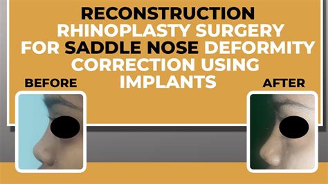 Reconstruction Of Saddle Nose Deformity Using Implants Transforming