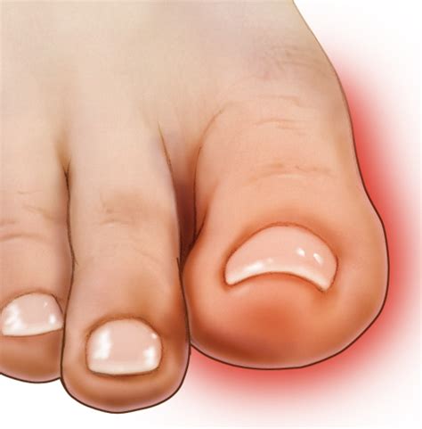 6 Common Problems That Make Your Big Toe Hurt Tanglewood Foot Specialists