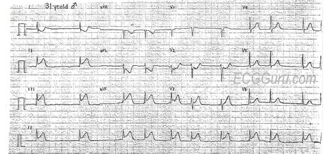 Acute Inferior Wall Mi With Right Ventricular Mi And Atrial
