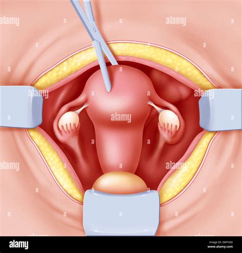 Hysterectomy Woman Fotograf As E Im Genes De Alta Resoluci N Alamy