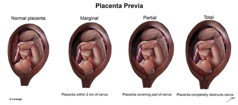 Placenta Previa Reproductive Medbullets Step 1