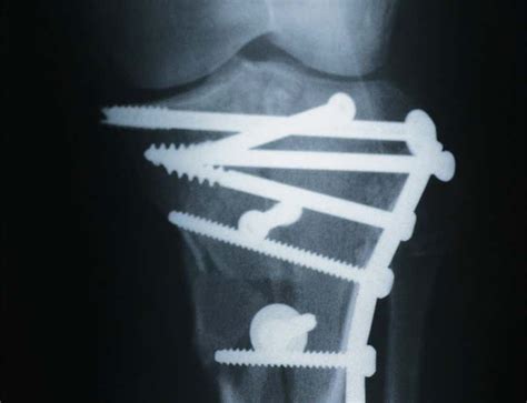This one is not too useful. Silk screws are strong enough to mend broken bones | New Scientist