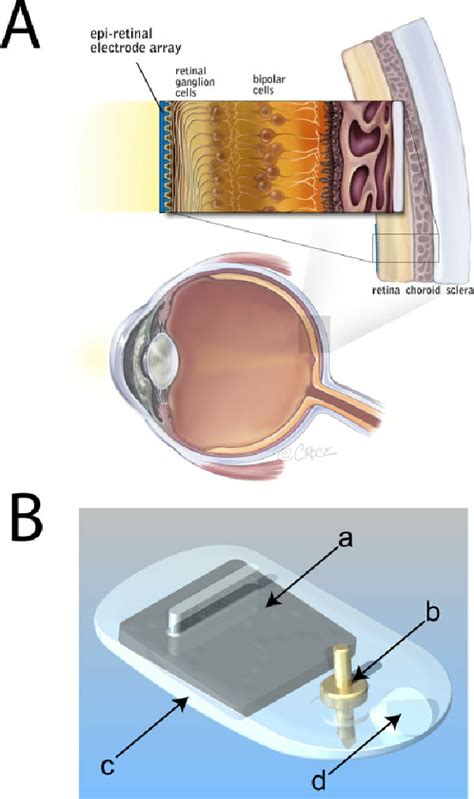 Placement Of An Epiretinal Electrode Array A Schematic Diagram Of