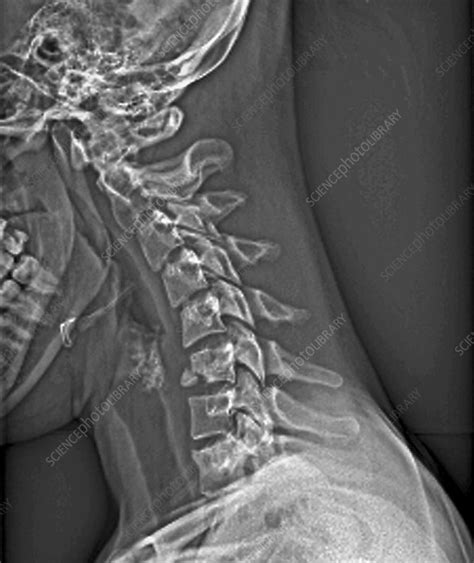 Fractured Neck X Ray Stock Image M3301728 Science Photo Library