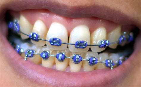 Tooth Trends Colored Braces