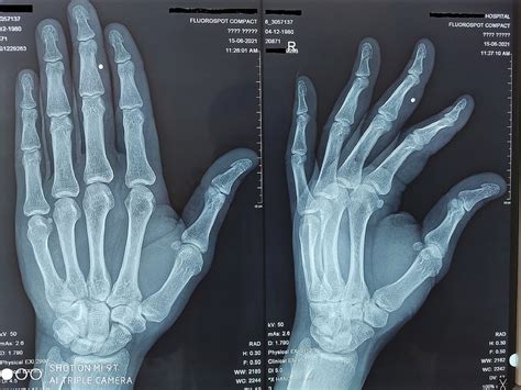 Plain X Ray Hand Pa View Shows Mild Subperiosteal Bone Resorption