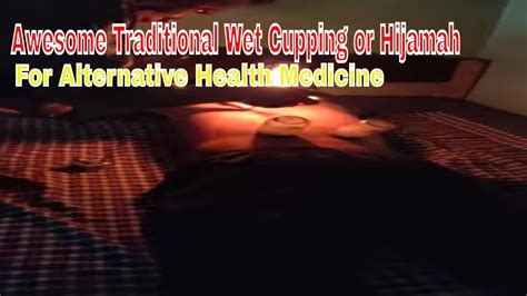 Awesome Traditional Wet Cupping Or Hijamah For Alternative Health Medicine You Must Try YouTube