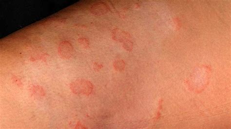 Psoriasis Eczema That Looks Like Ringworm