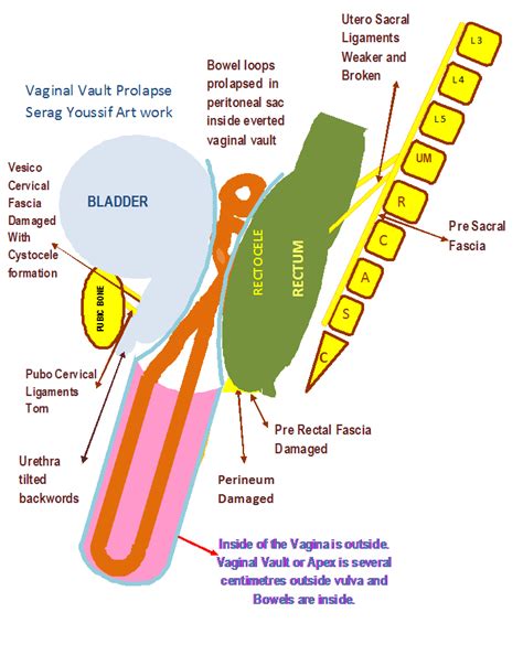 Vaginal Vault Prolapse