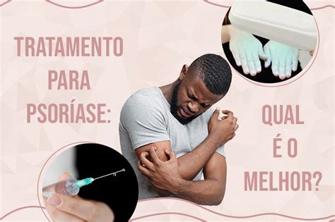 Tratamento Para Psoríase Qual é O Melhor Psoríase Brasil