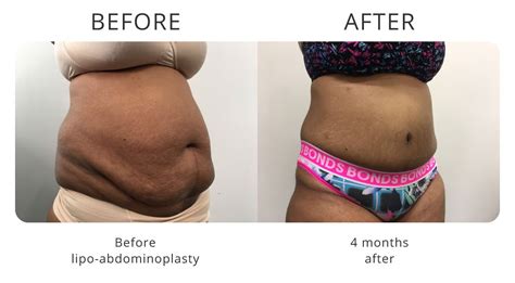 Looking For Tummy Tuck Sydney My Cosmetic Clinic