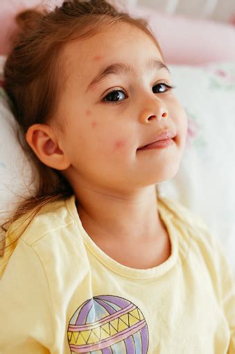 Dzieci Choroba Wirusowa Lub Alergie Czerwona Wysypka Odry Na Małej