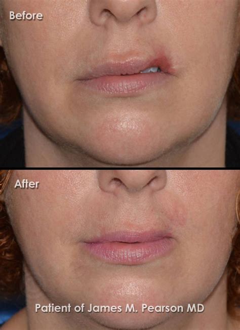 Pearson Lip Reconstructive Surgery Before And After Photos Dr
