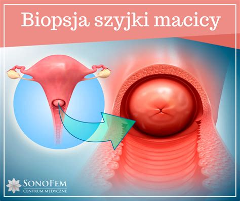 Biopsja Szyjki Macicy Sonofem Centrum Medyczne Warszawasonofem Centrum Medyczne Warszawa