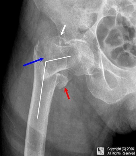 Learning Radiology Fractures Of The Proximal Femur